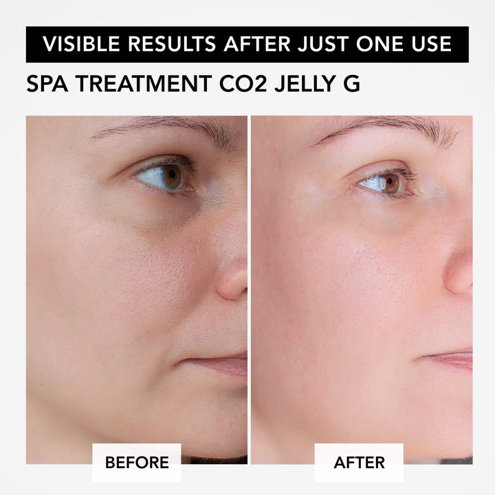 Карбокситерапія Spa Treatment CO2 Jelly G- EXC.UA 